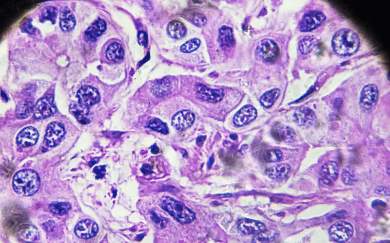 What Is Hepatocellular Carcinoma Understanding the Liver's Deadliest Foe