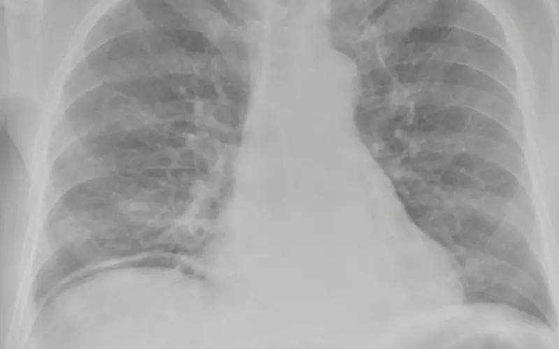 10 Symptoms of Pneumoperitoneum What Every Individual Should Be Aware Of