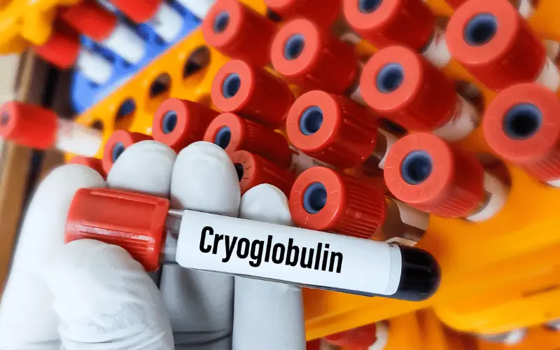 10 Tell-Tale Symptoms of Cryoglobulinemia You Shouldn't Ignore
