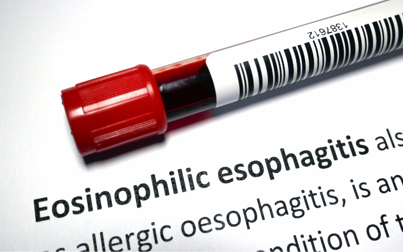 15 Essential Facts You Must Know About Eosinophilic Esophagitis (EoE)