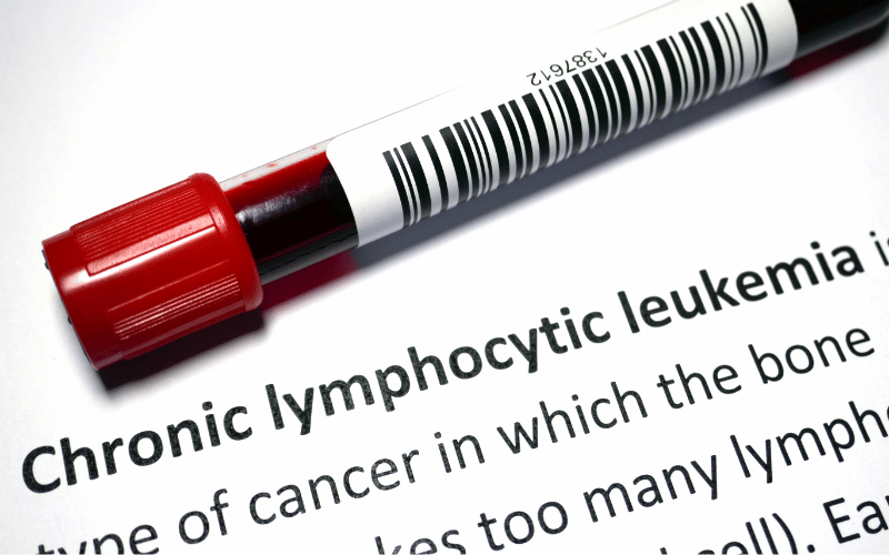 15 Important Facts About Chronic Lymphocytic Leukemia (CLL, B-cell Chronic Lymphocytic Leukemia)