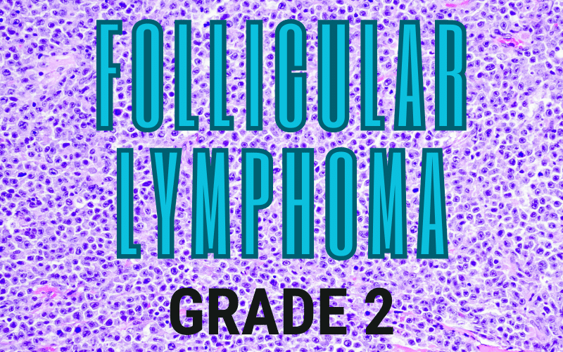 Balanced Complexity Follicular Lymphoma's Grade 2 Interplay