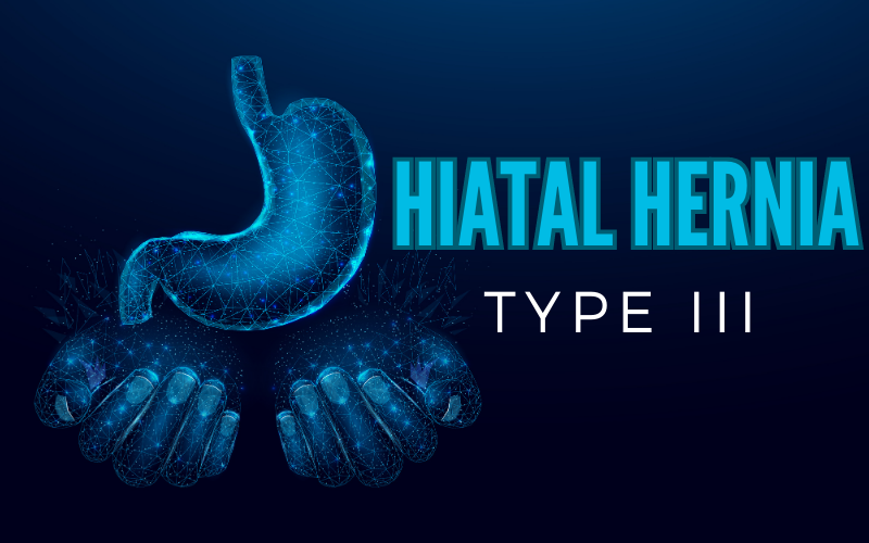 Mixed Hiatal Hernia The Complex Combination