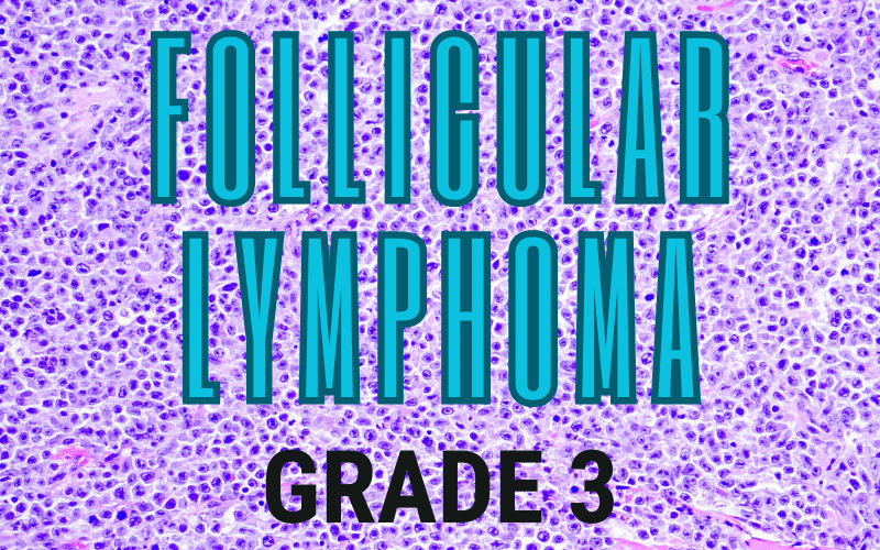 The Aggressive Anomaly Delving into Follicular Lymphoma Grade 3