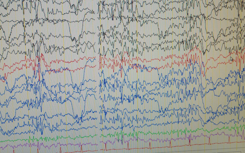 The Diagnostic Journey Identifying Myoclonic Epilepsy