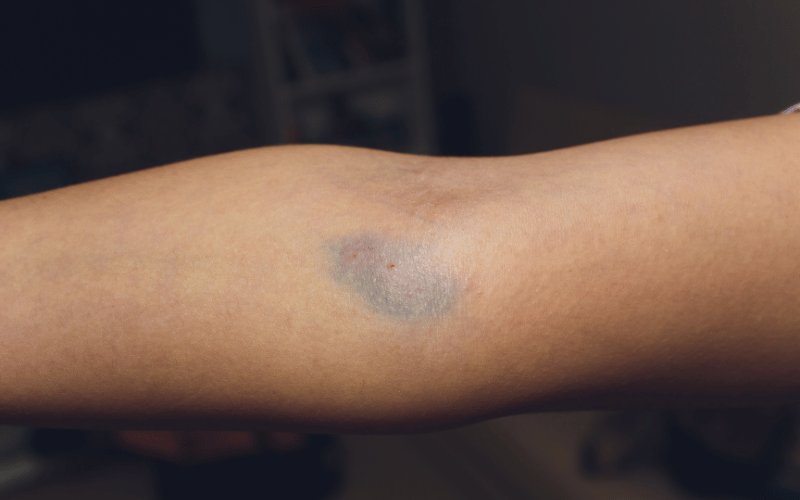 Unexplained Bruising The Mysterious Marks