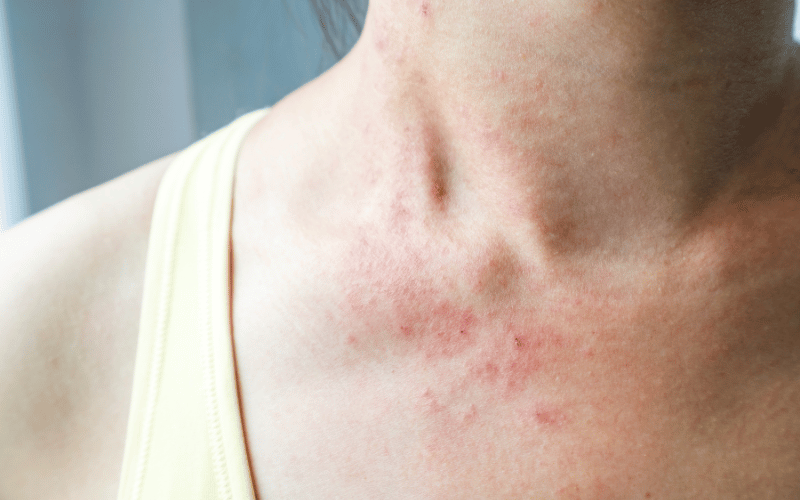 A Skin’s Red Signal The Rash