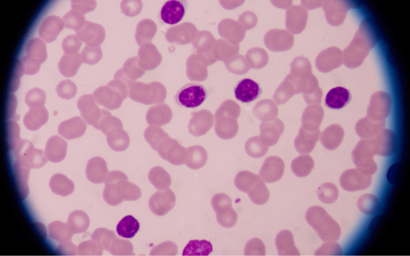 5 Stages of Chronic Lymphocytic Leukemia (CLL) A Deep Dive into B-cell Chronic Lymphocytic Leukemia