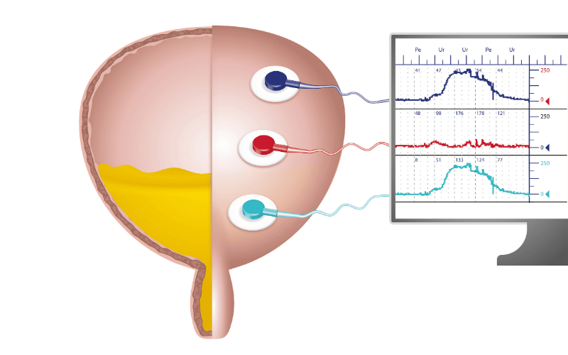 Bladder Dysfunction The Unspoken Challenge of Tabes Dorsalis