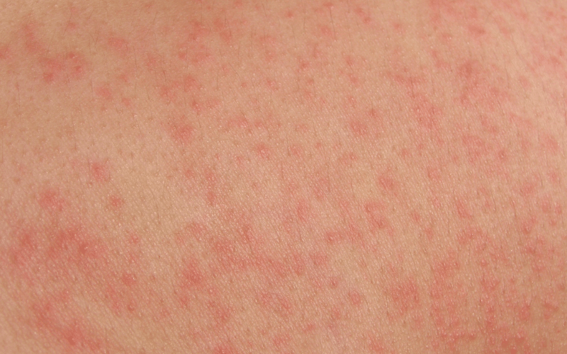 Rash The Skin's Response to Epstein-Barr Virus