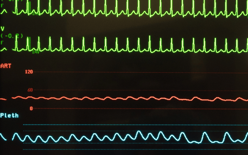 Tachycardia Hemoperitoneum's Rapid Response