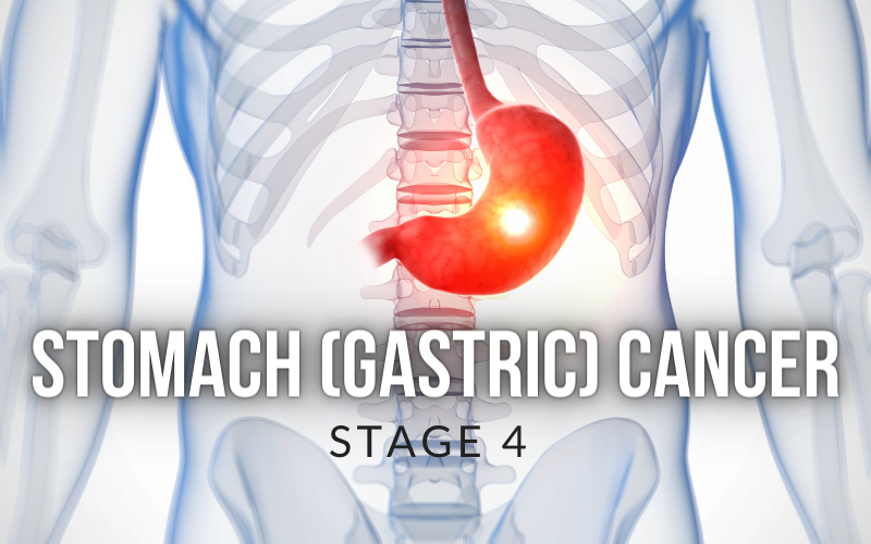 The Final Frontier Stage IV Gastric Cancer