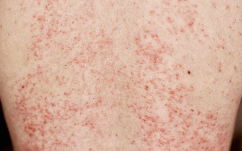 Skin Rashes The External Echo of an Internal Struggle