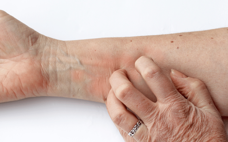 Persistent Itchiness The Underlying Tug of Hodgkin Lymphoma