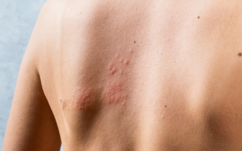 Skin Rashes ALCL's External Warning Flag