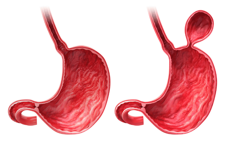 The Esophagitis-Hiatal Hernia Connection A Surprising Relationship