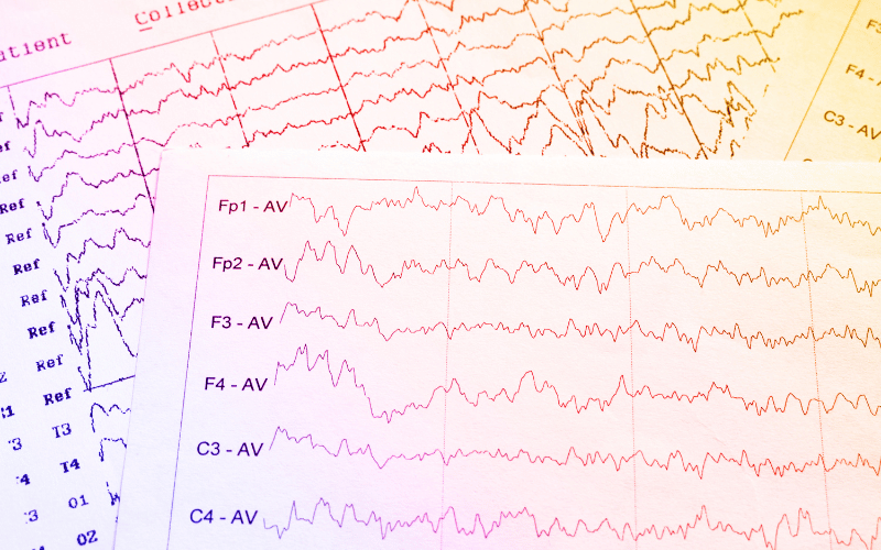 Slow Wave Pattern on EEG - The Silent Whisperers