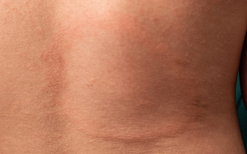 Evanescent Erythema The Fleeting Redness of PLC