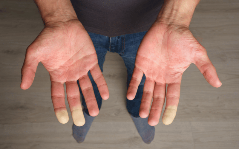 Raynaud’s Phenomenon Sjogren’s Icy Touch on the Extremities