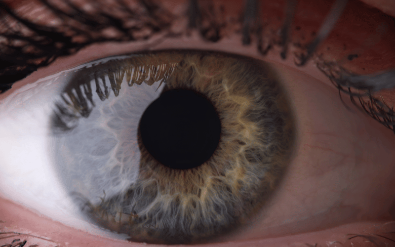 Relative Afferent Pupillary Defect (RAPD) – The Eye's Telltale Signal in Optic Neuropathy