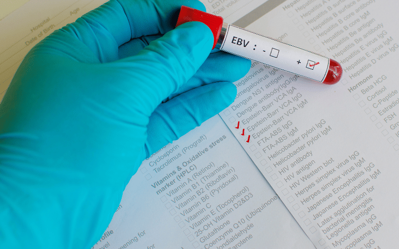 EBV and Hodgkin Lymphoma An Unexpected Connection