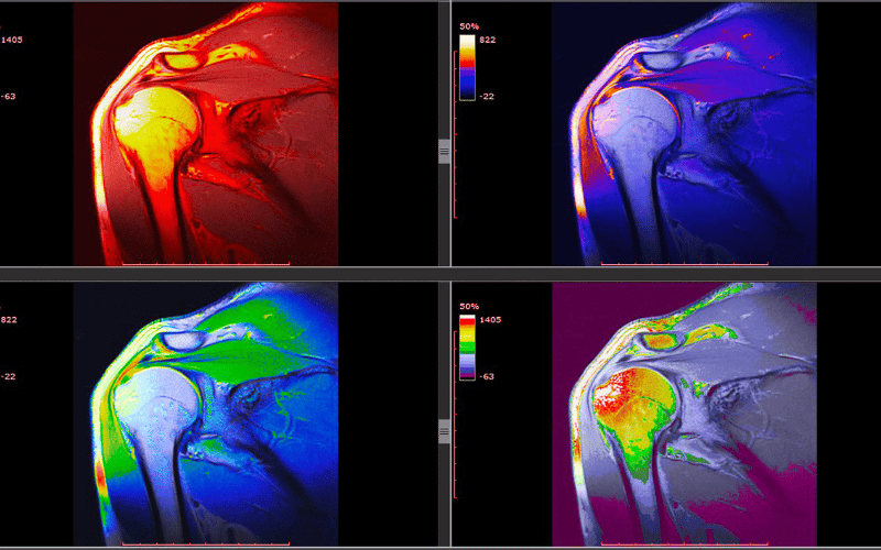 Muscular Strains The Physiological Struggles and Lifespan Determinants