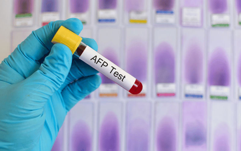 Alpha-fetoprotein (AFP) Levels - A Prognostic Beacon