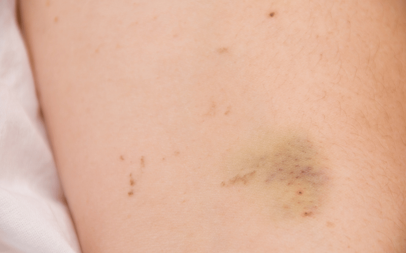 Bleeding or Bruising Easily