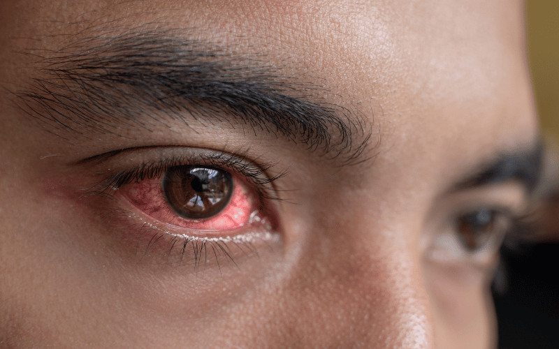 Cherry Red Spots in the Eyes A Unique Symptom Explained