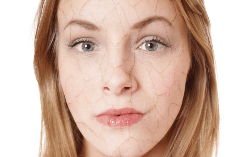 Dry Skin The Desiccating Effect of Mycosis Fungoides