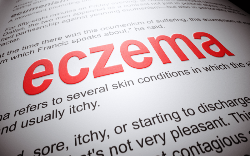 Eczema