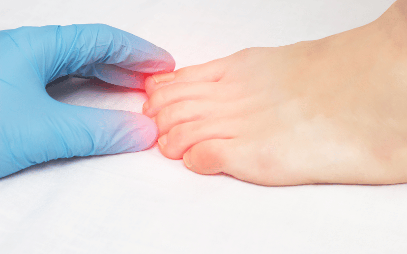 Frequently Asked Questions (FAQs) about Mycosis Fungoides
