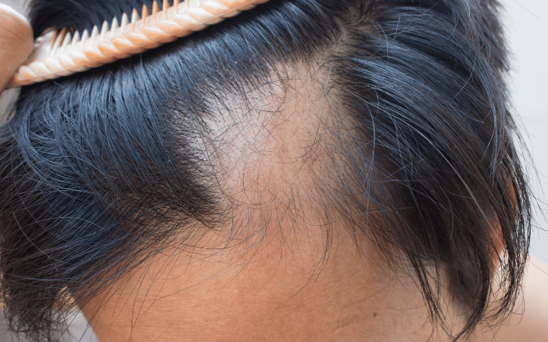 Hair Loss An Unintended Consequence