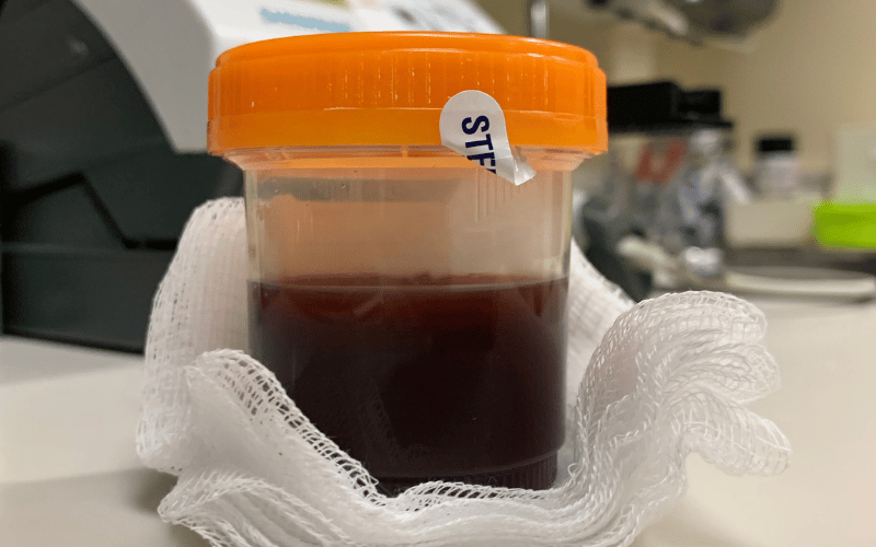 Hematuria (Blood in Urine)