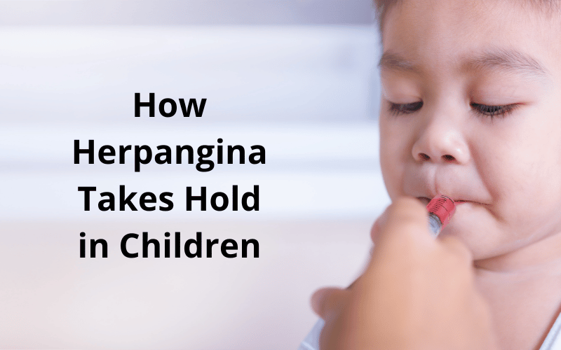 How Herpangina Takes Hold in Children