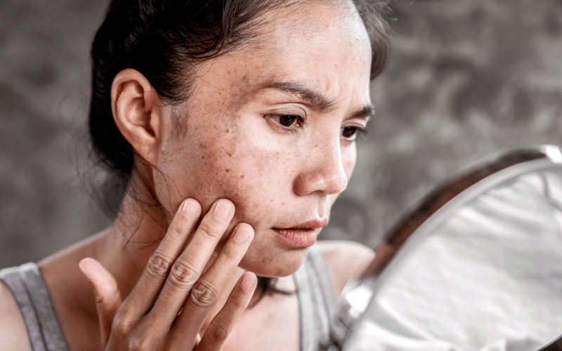 Hyperpigmentation or Darkening of the Skin