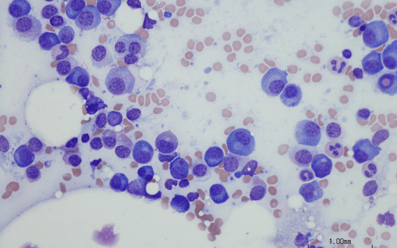 IgD Myeloma