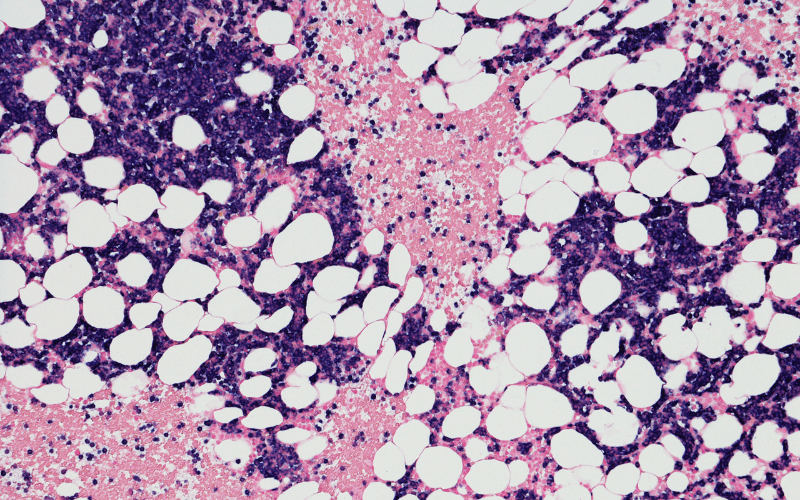 Light Chain Myeloma (Bence Jones Myeloma)