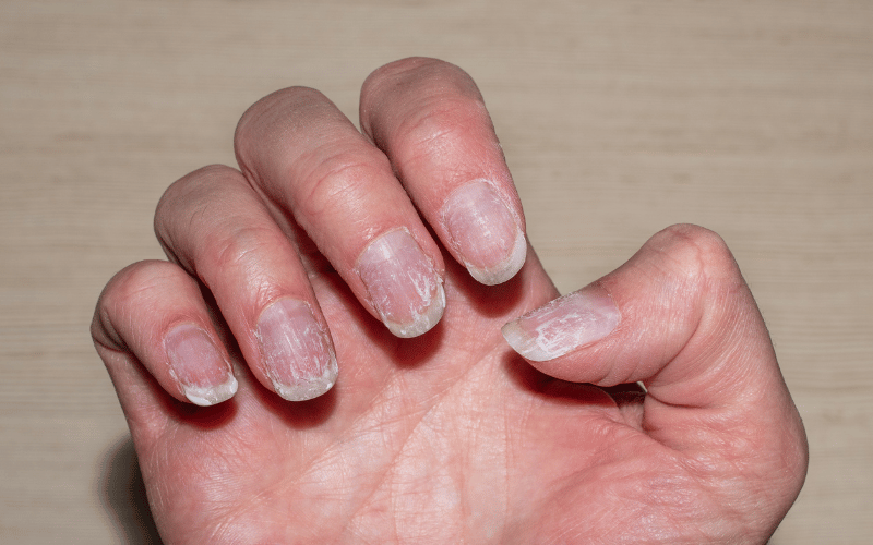 Nail Damage