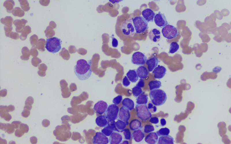 Non-secretory Myeloma