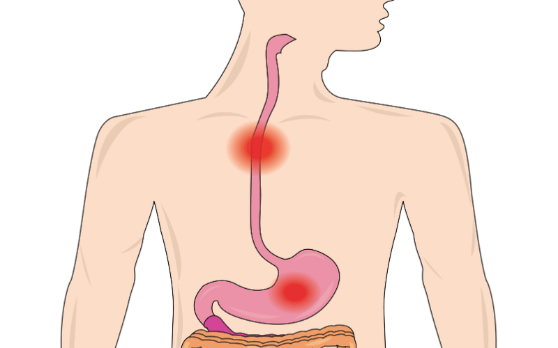 Potential for Esophageal Scarring