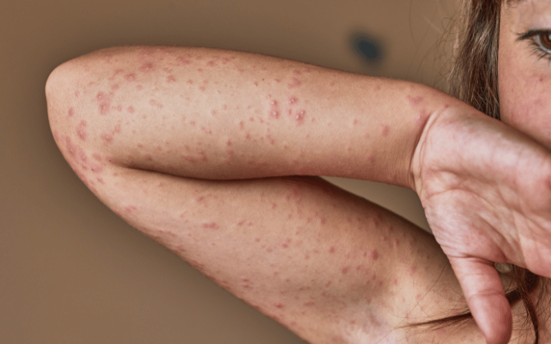 Skin Infections and Rashes The External Markers of Internal Strife