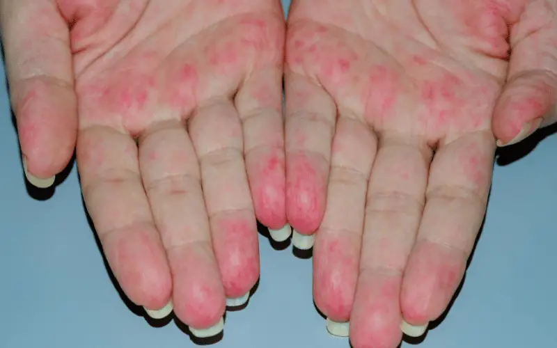 Skin Lesions and Rashes