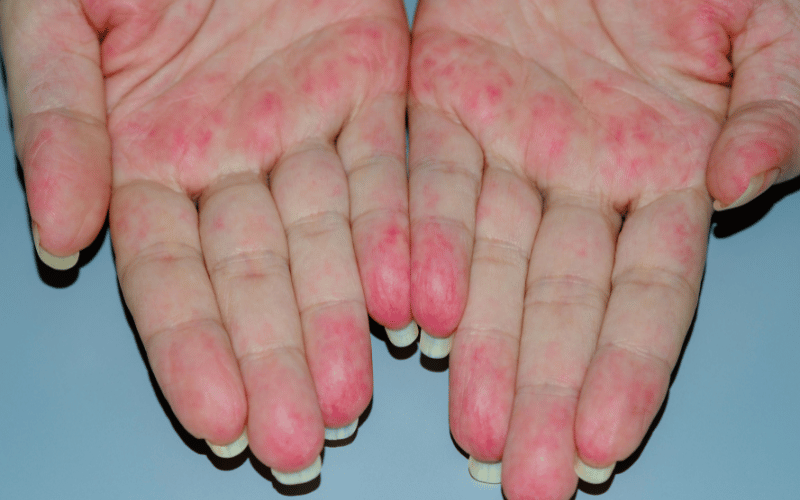 Skin Lesions and Rashes