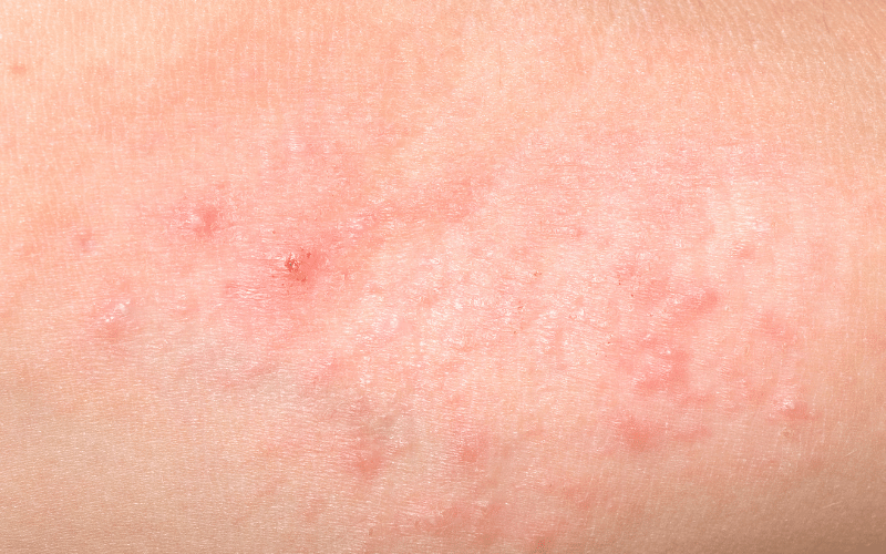 Skin Rashes