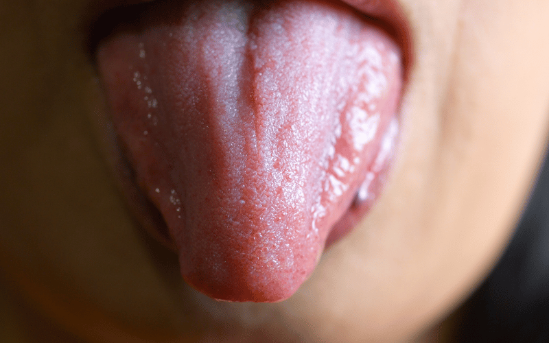 The Top 10 Symptoms of Hairy Leukoplakia What You Need to Know