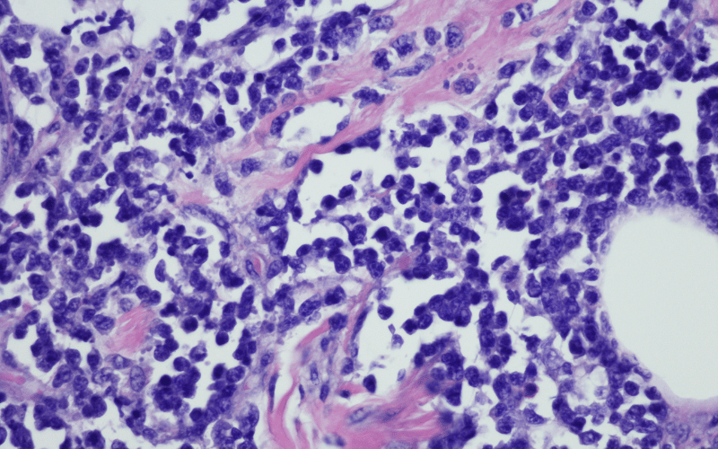 Unmasking Burkitt Lymphoma