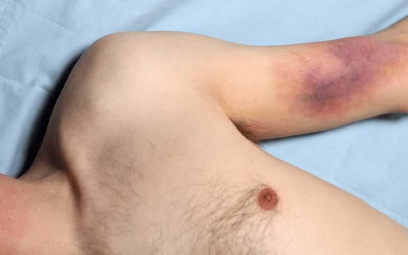 Unusual Bleeding or Bruising