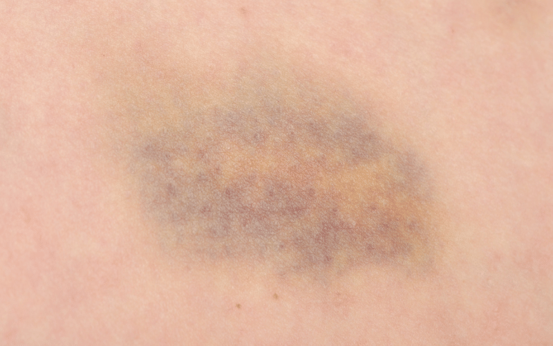 Unusual Bruising