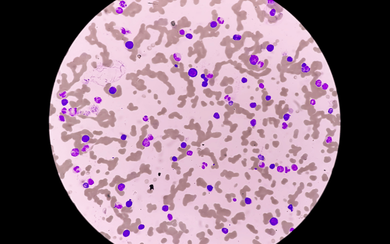 What is Waldenstrom Macroglobulinemia